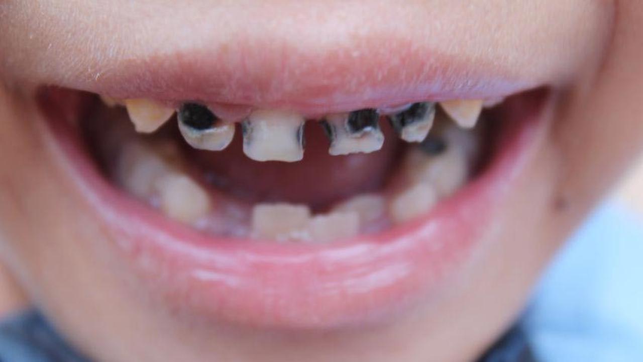 Kebiasaan Harian Yang Bisa Merusak Gigi Pada Anak